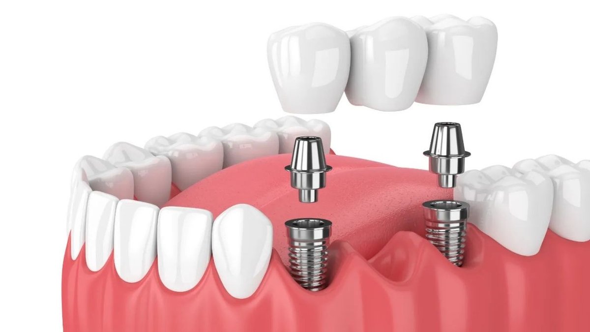 Diş İmplantı Nedir? Kimler İçin Uygundur ve Nasıl Uygulanır?